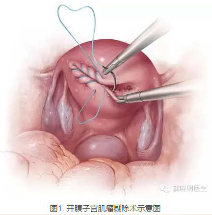 龔曉明：1/3女性都有的子宮肌瘤到底是啥