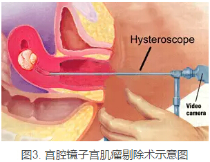 龔曉明：1/3女性都有的子宮肌瘤到底是啥