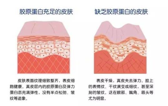 注射膠原蛋白真的能改善臉部皺紋？